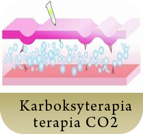 Karboksyterapia