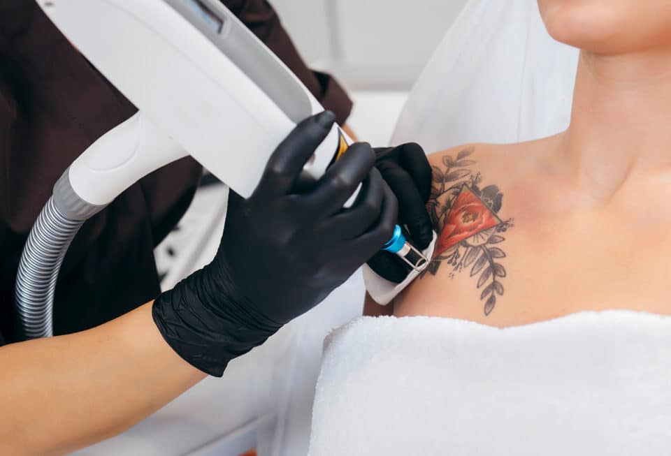 laserowe-usuwanie-tatuazu